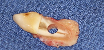 eye_surgery_tooth_with_hole